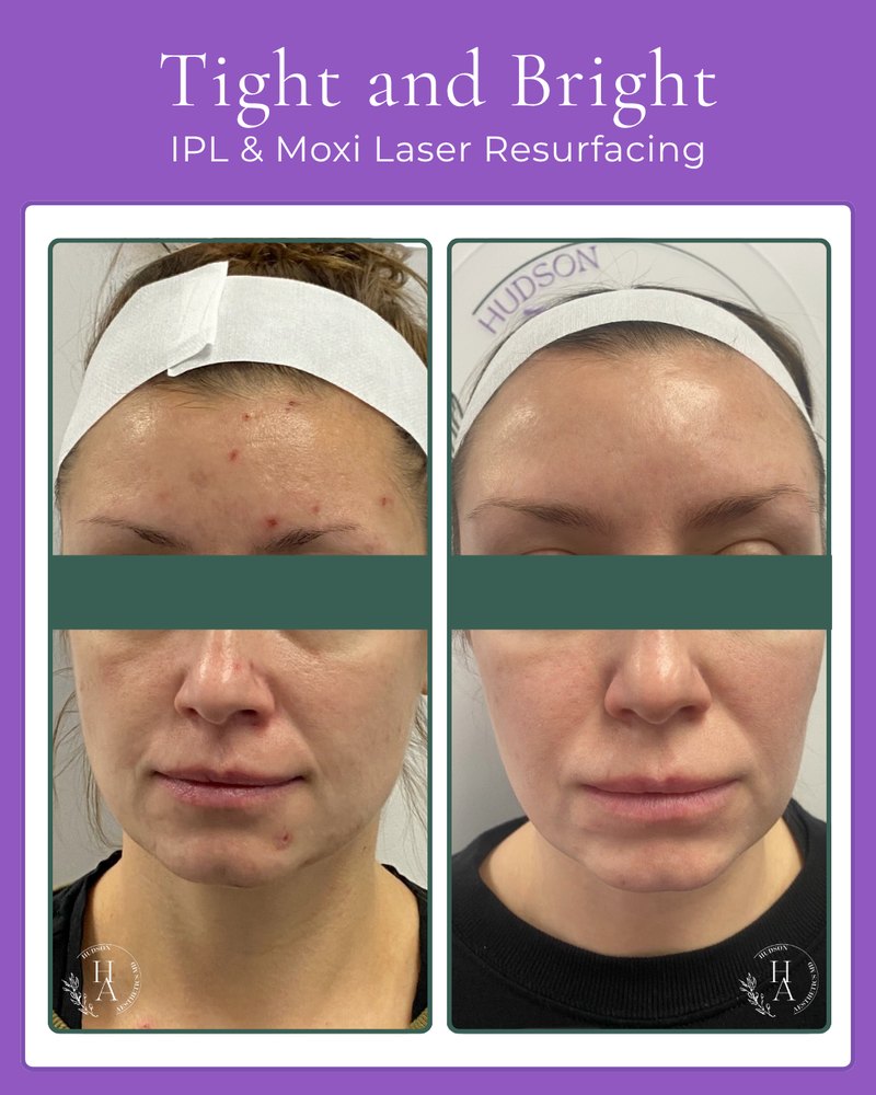 Before and after IPL and Moxi laser resurfacing: redness and breakouts across the forehead and cheeks visibly calmer afterwards