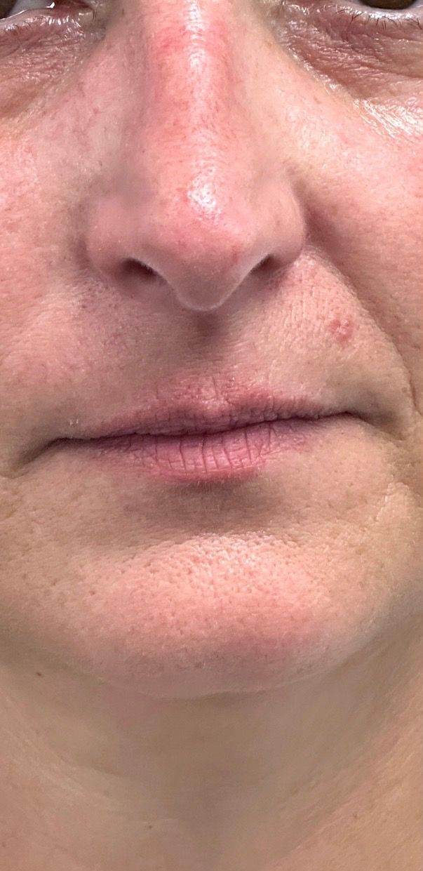 A patient’s lips before a gradual lip filler build at Hudson Aesthetics MD