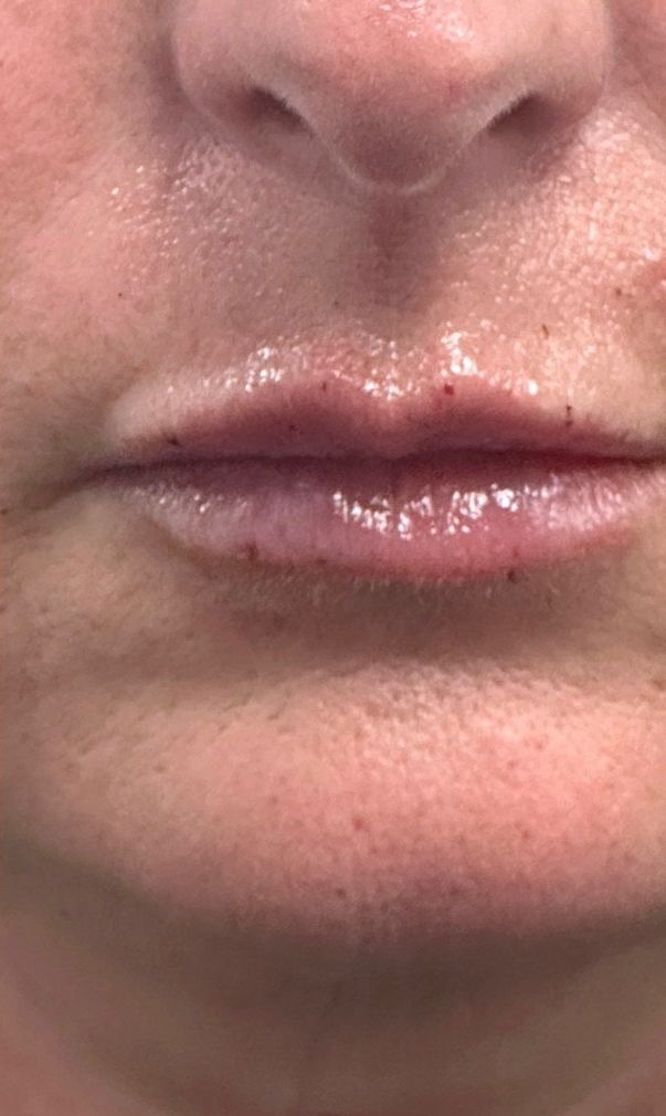 The same patient’s lips after lip filler at Hudson Aesthetics MD