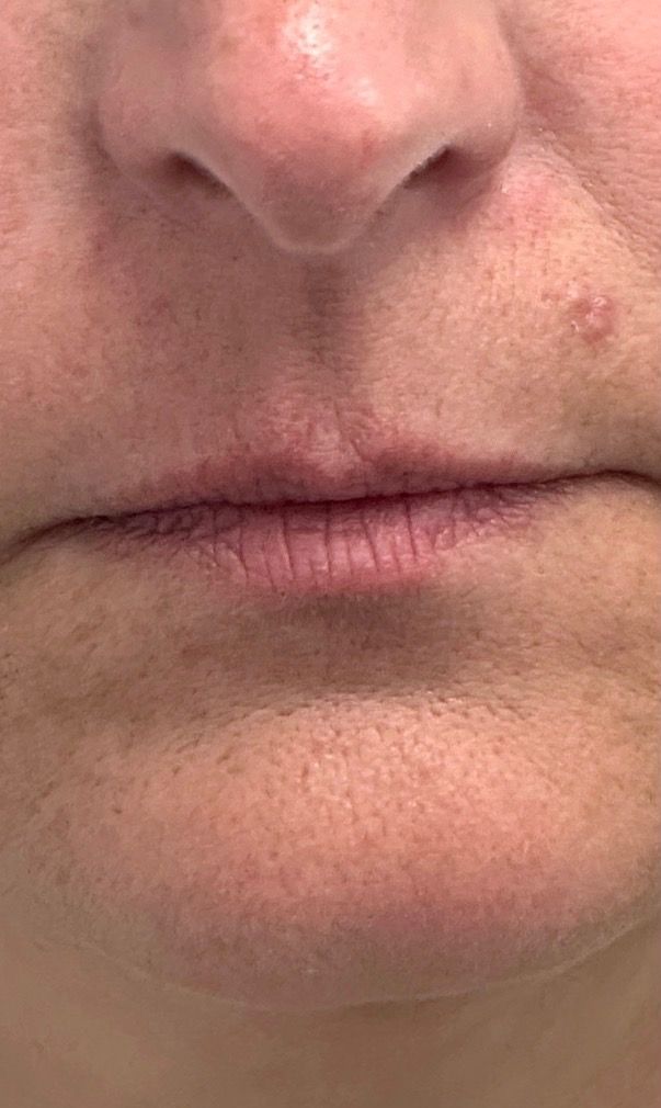 A patient’s lips before lip filler at Hudson Aesthetics MD