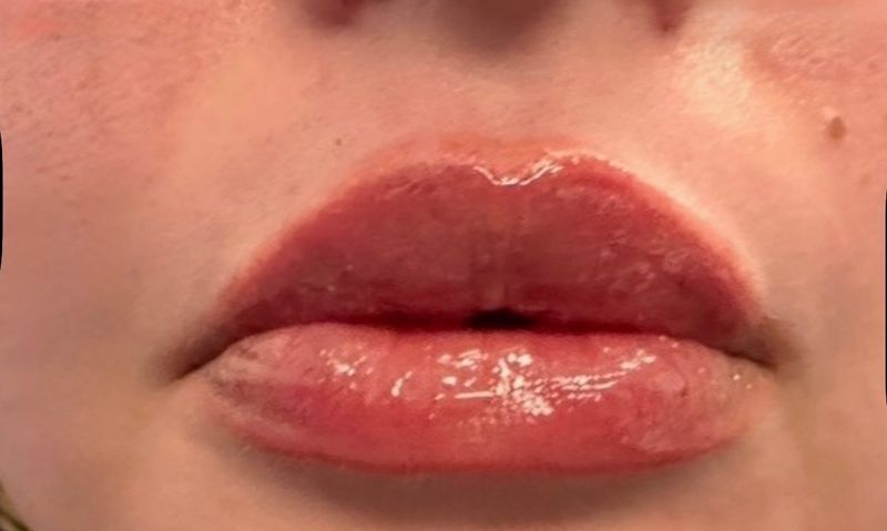 The same patient’s lips after a lip filler treatment at Hudson Aesthetics MD, fuller and more defined