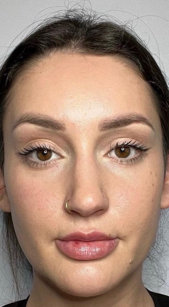 The same patient’s face after masseter neurotoxin injections at Hudson Aesthetics MD