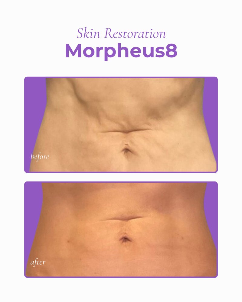 Before and after Morpheus8 on the abdomen: loose, crepey skin around the navel looks smoother and firmer after treatment