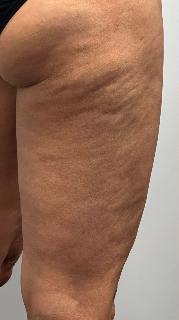 A patient’s thigh before Morpheus8 body treatment at Hudson Aesthetics MD