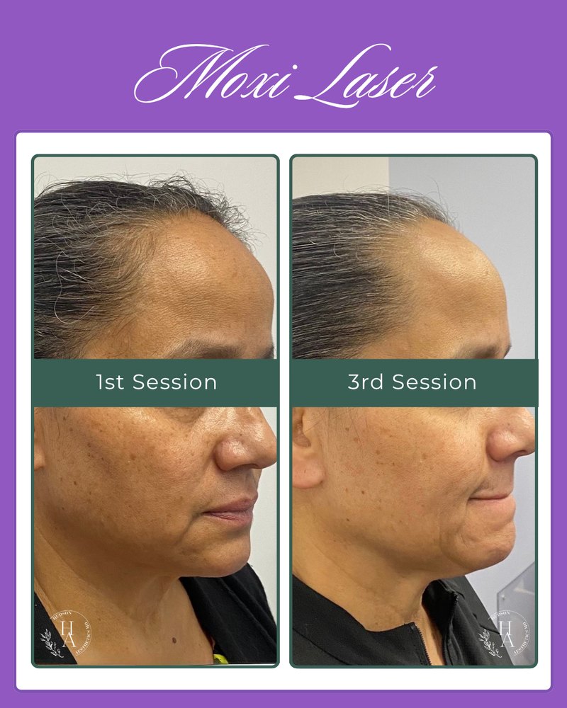 Moxi laser results: a patient’s cheek after her first session and after her third, with more even tone and texture
