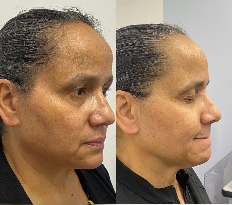Moxi laser results for texture and hyperpigmentation: a patient’s profile in September 2024 and again in February 2025