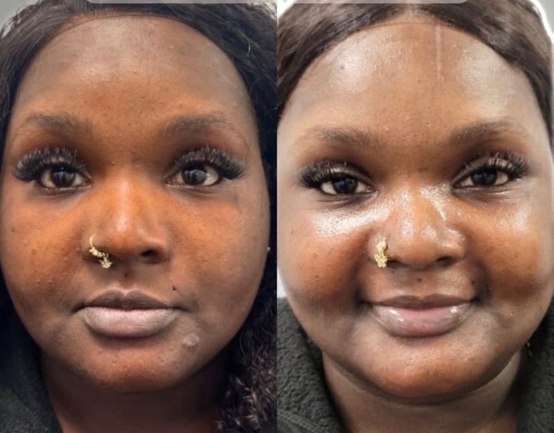 Moxi laser results: a patient’s face before (left) and after (right), with more even tone and clearer texture