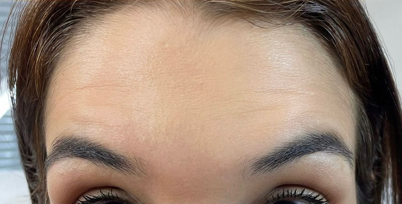 The same patient’s forehead after neurotoxin injections at Hudson Aesthetics MD