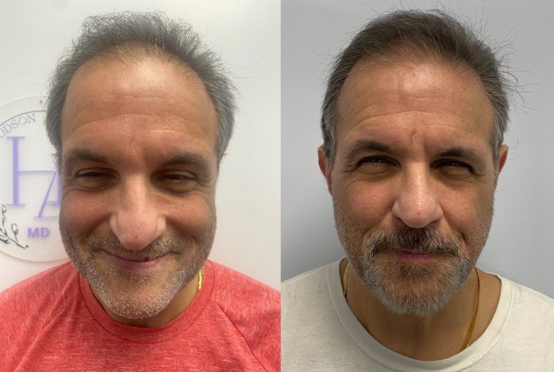 PRP hair restoration results: a patient’s hairline before treatment and after, with visibly denser hair at the front