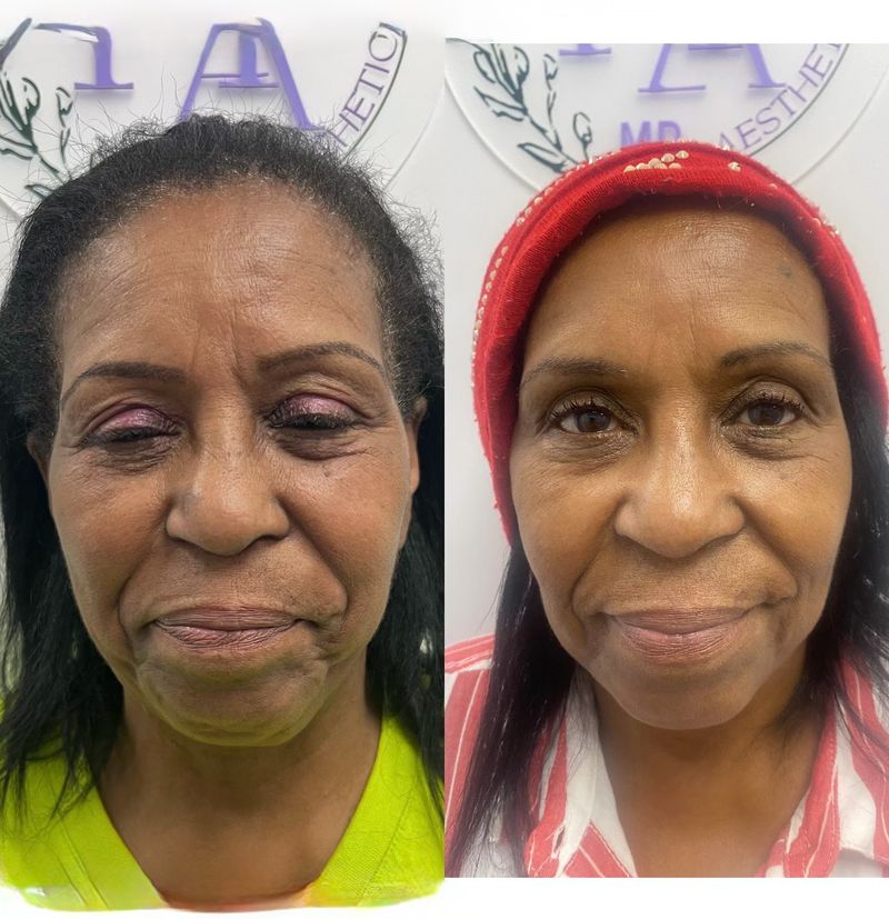 Sculptra results: a patient’s face in May 2024 and again in October 2025, with fuller cheeks and softer lines