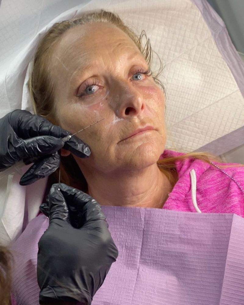 A Sculptra treatment in progress at Hudson Aesthetics MD, a gloved hand at the patient’s cheek
